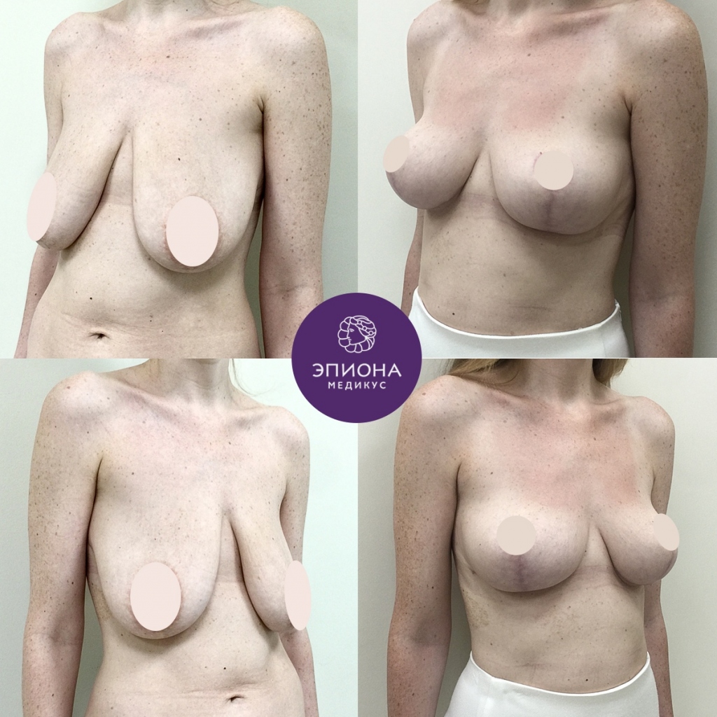 отзывы женщин о подтяжке груди фото 118