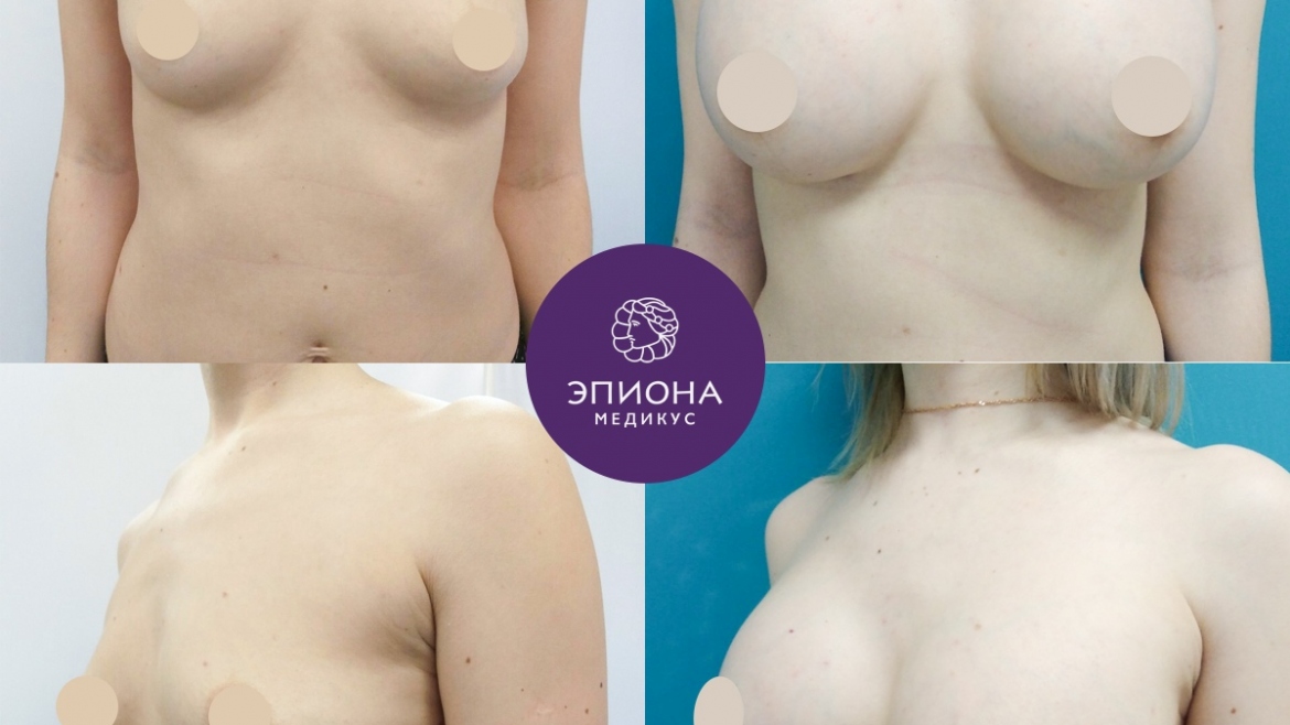 Эндопротезирование груди