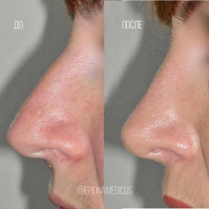 Ринопластика носа։ ДО и ПОСЛЕ