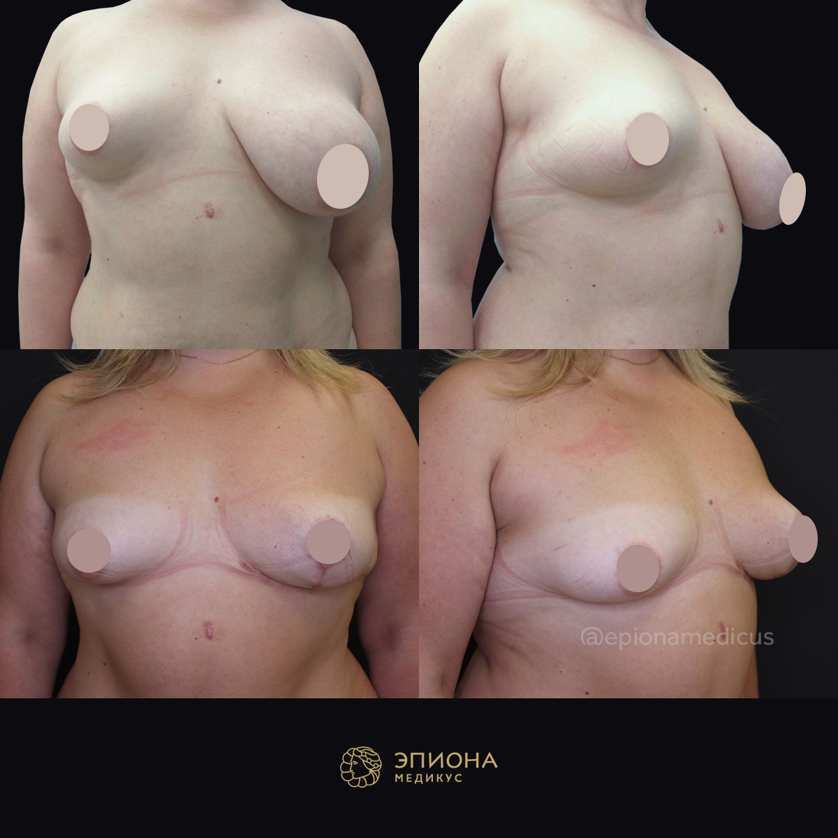уменьшение груди у женщин причины фото 63