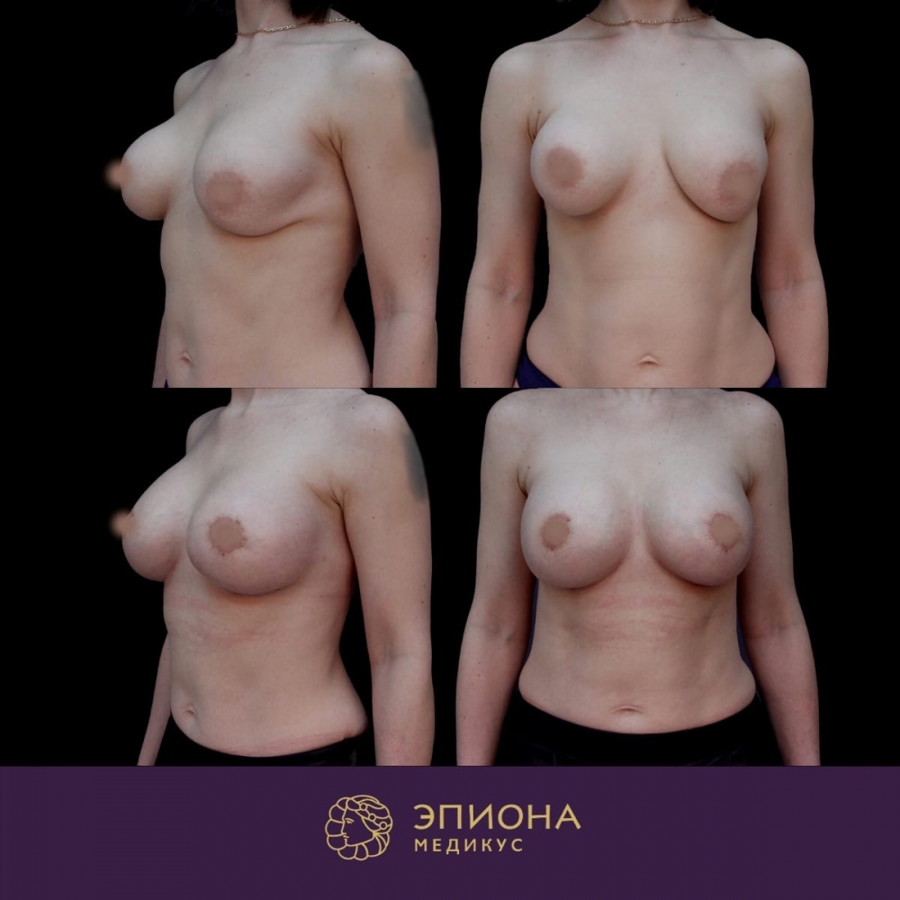 уменьшение объема груди у женщин фото 117